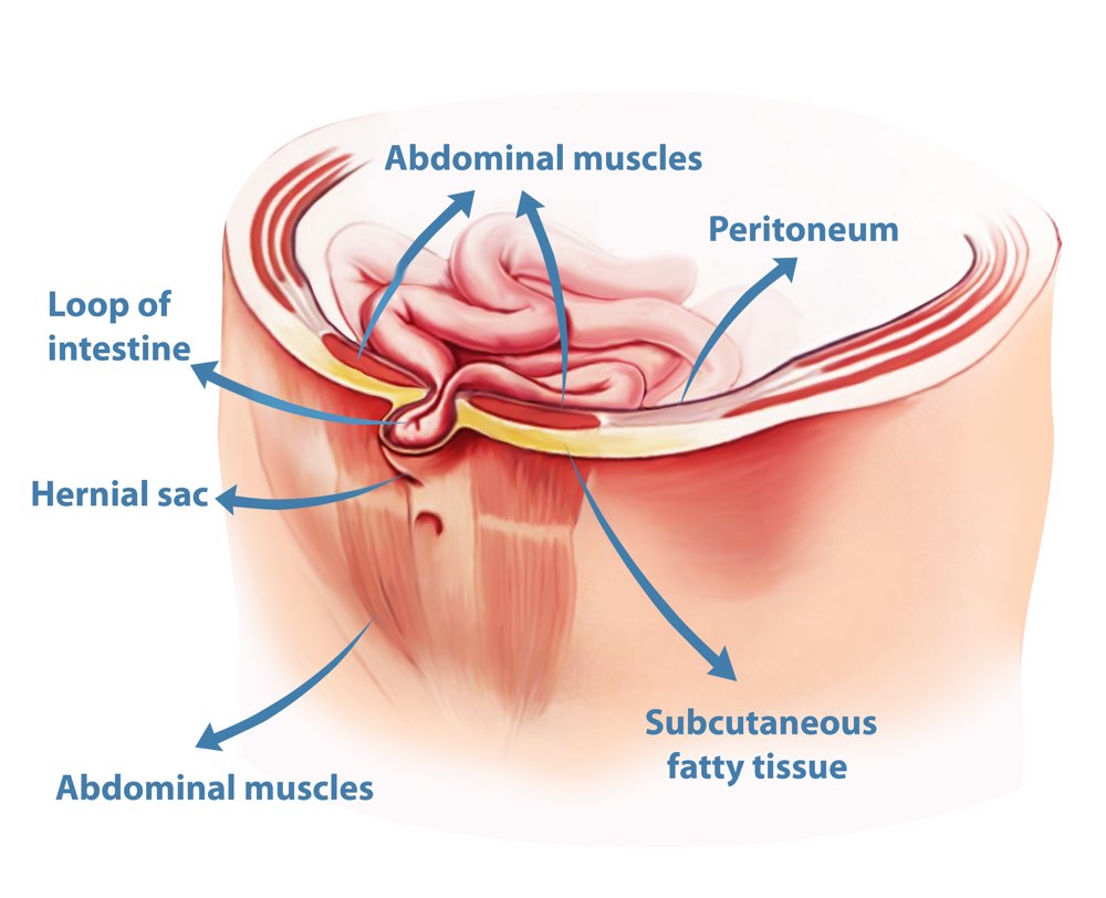 types of hernia