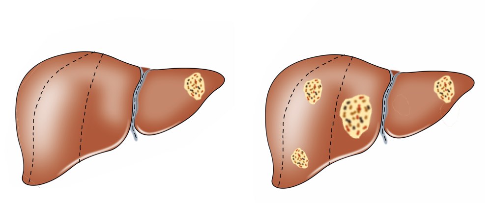 liver cancer