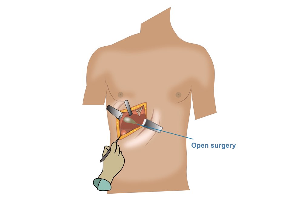 gallbladder surgery