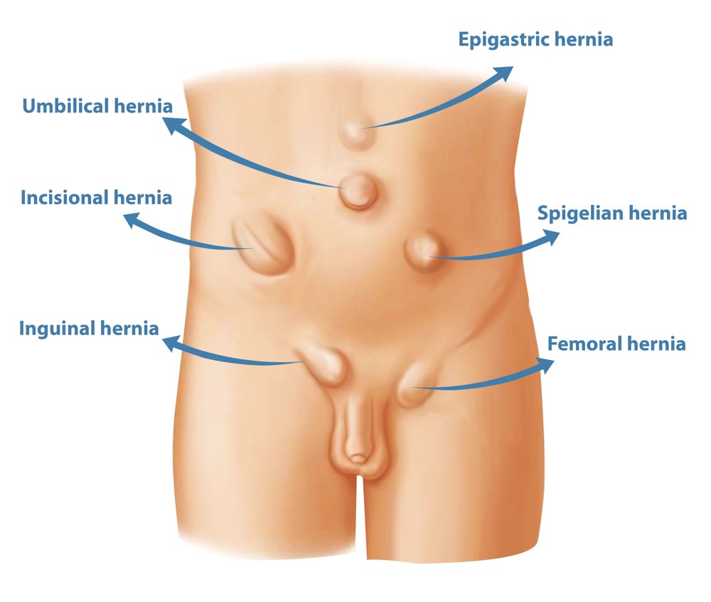 types of hernia