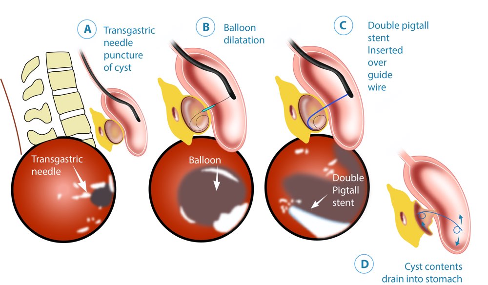 pancreas surgery