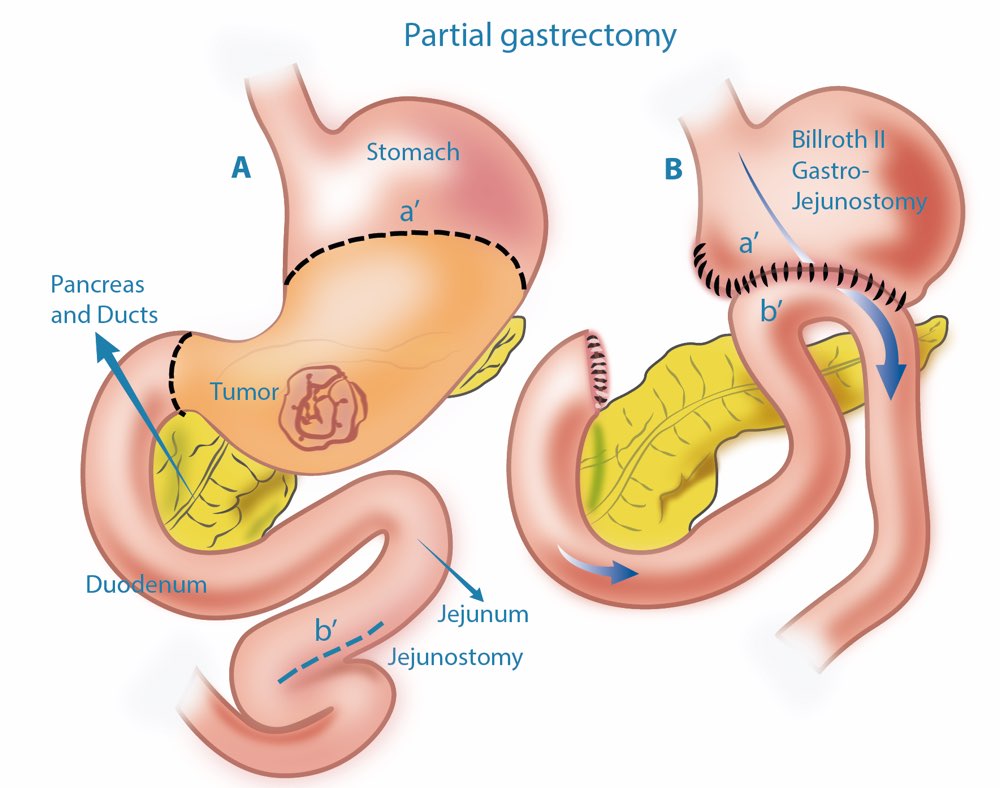 stomach cancer surgery