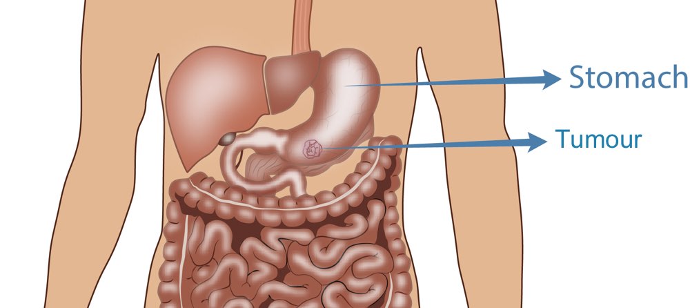 Most small bowel cancers are revealed by a complication