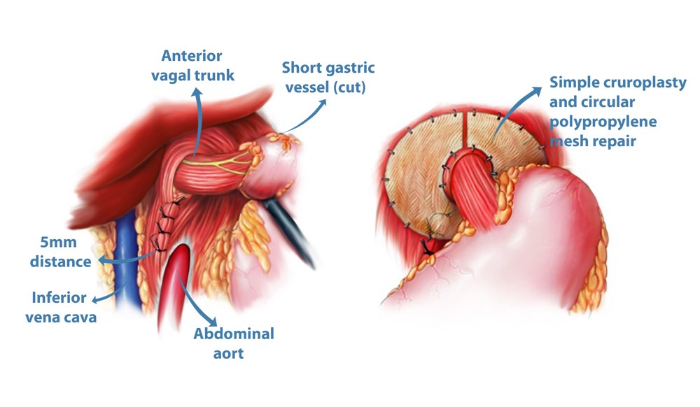 Surgery for Benign Gastro-Oesophageal Disorders